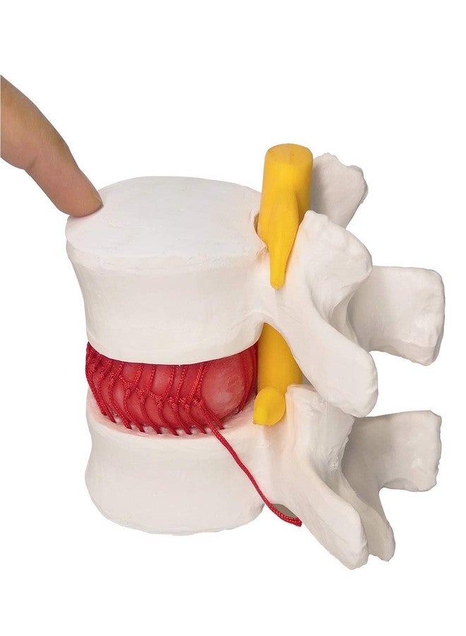 EVOTECH SCIENTIFIC Human Herniated Disc Model, Anatomical Herniated Lumbar Vertebrae Disc Prolapse Model for Medical Teaching Learning, Education Display Tooling, Student Learning Education Display Tool 3 Pack - Image 5